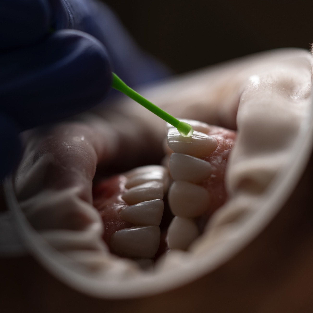 Cracked Teeth Treatment at Legacy Family Dental