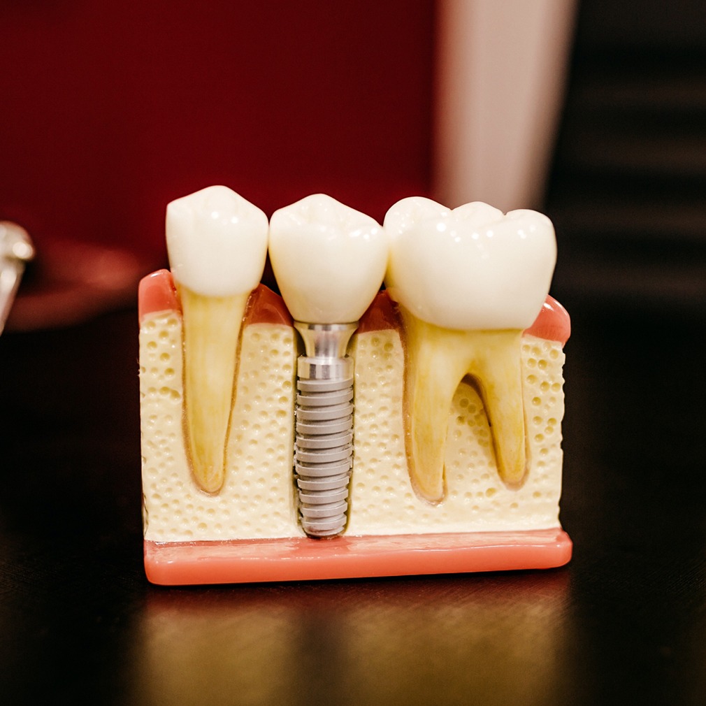 Dental Implants at Legacy Family Dental