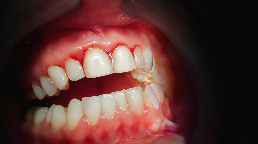 Signs of Gum Disease Periodontal