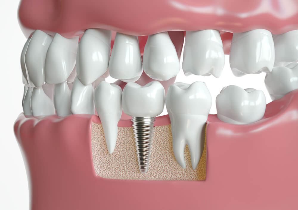 Dental Implants Murfreesboro TN